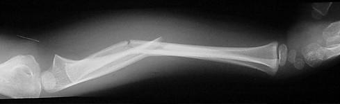 Fractures of the Radial and Ulnar Shafts In the Pediatric Patient Kaye E Wilkins