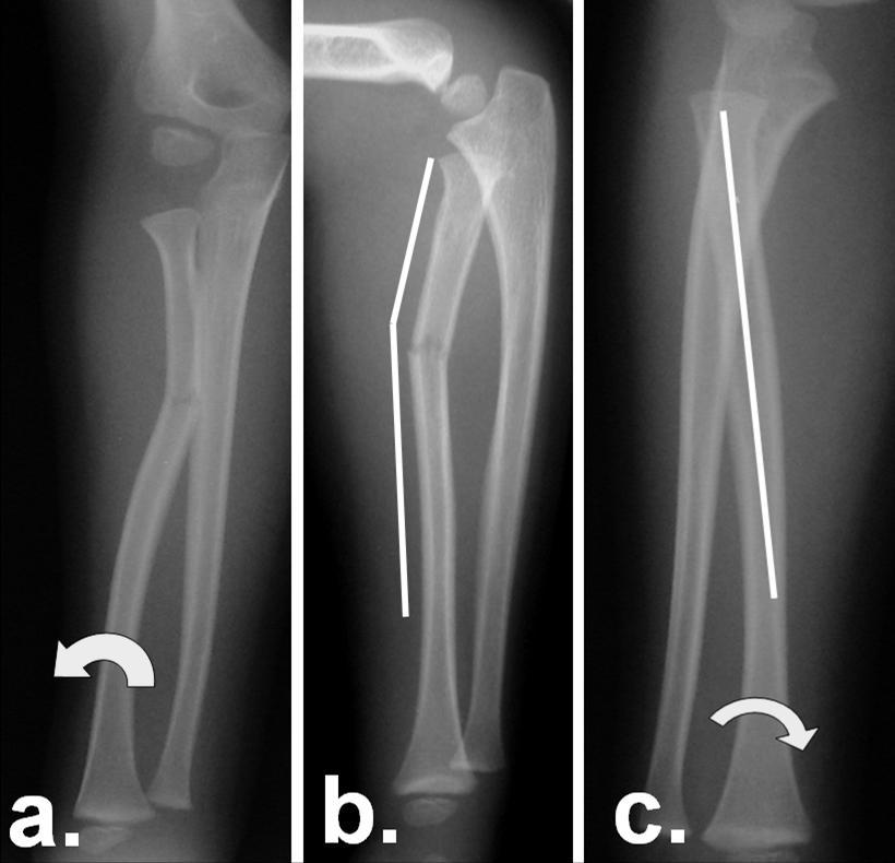 4 c. Treatment. To reduce these fractures both the angular and rotational components need to be corrected.