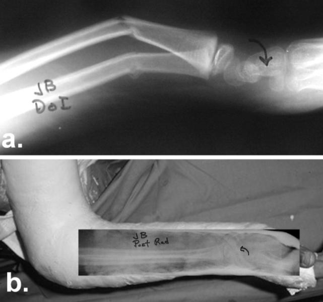 5). Figure 5. Supination to pronation. a. Injury image demonstrating supination of the distal fragment.(curved arrow). b. The apex is directed volar. c.