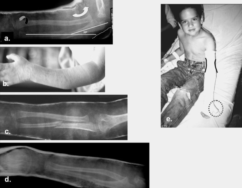 6 Figure 27. Long arm elbow extension cast. a. X-rays taken two weeks postreduction demonstrating pronation of the distal fragment (grey arrow) and 20 0 of apex posterior angulation.