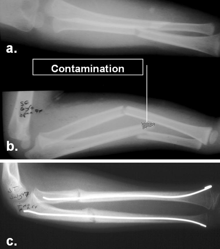 7 Figure 28. Intramedullary stabilization. a,b. Injury images of a 6 year old female with a Grade I open fracture of the ulna shaft. It had minimal co
