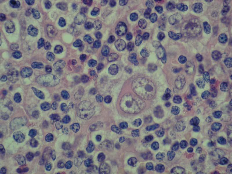 Podtip mešovite celularnosti (slika 2) karakteriše relativno veliki broj klasičnih Reed-Sternberg ćelija i njenih varijanti, prisustvo zapaljenskog