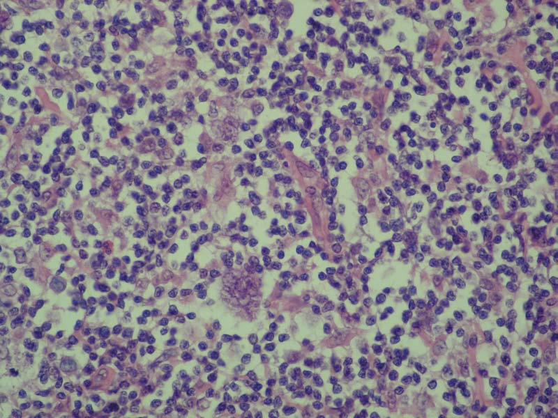 Limfocitima bogat klasičan Hočkinov limfom (slika 3) odlikuje mali broj Reed- Sternbergovih ćelija koje morfološki i imunofenotipski odgovaraju malignim ćelijama u klasičnom
