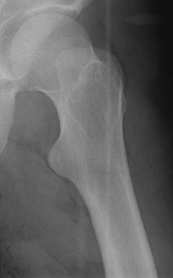 Types of hip fractures Acetabulum Greater Trochanter Head Lesser Trochanter 1.