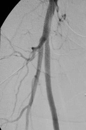 RT Femoral Angiogram 1. Medial Femoral Circumflex Artery 2. Ascending LFCA 3. Transverse LFCA 4.