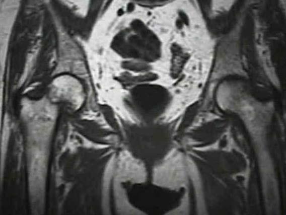 Garden Type III Fracture T1 MRI complete femoral neck
