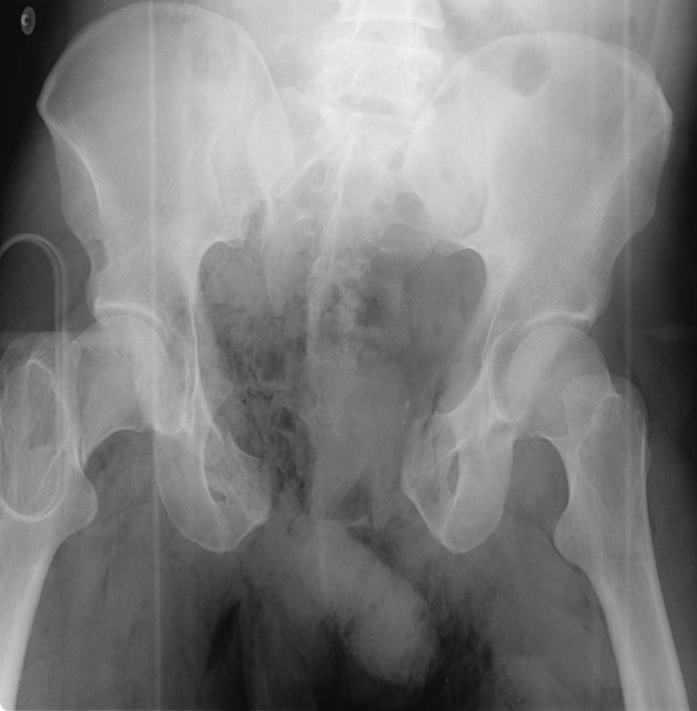 P2 Radiograph 1 Sacroiliac fracture and widened pubic symphysis