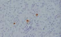 T-cells Mixed Response Anti-CD25 RIT CR SFC per 2x1 5 cells pre wk3 wk6 wk8 mth3