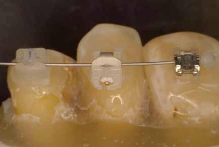 deionized water. Brackets were bonded using orthodontic adhesive without primer/sealant. A.019 x.025 stainless steel wire was engaged to tax them with appropriate force.