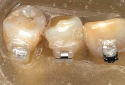 The force levels documented represent total force. Because the total occlusal force is distributed over three teeth, the approximate force applied to each tooth is the total force divided by three.