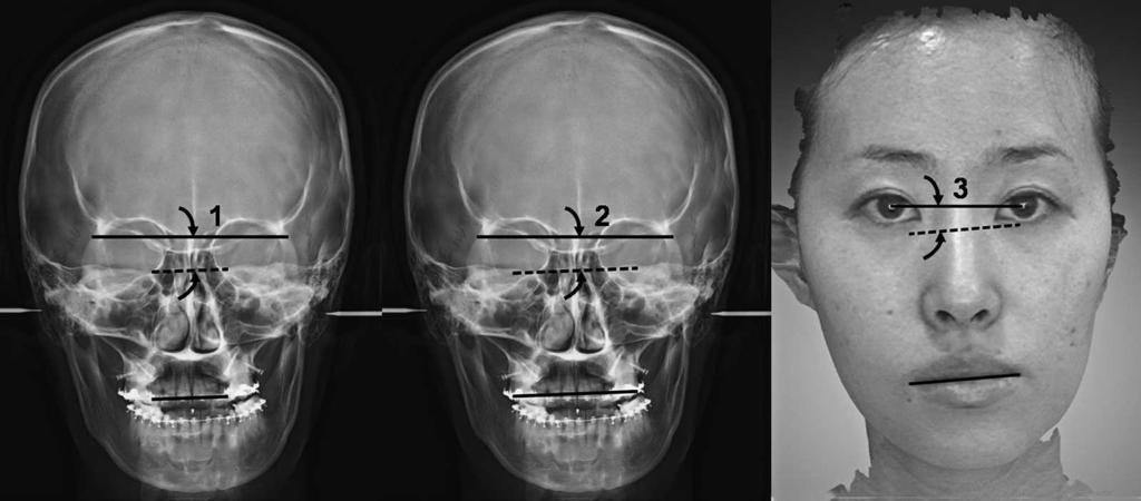 CANTING CORRECTION IN CLASS III TWO-JAW ORTHOGNATHIC SURGERY 1095 Figure 3.