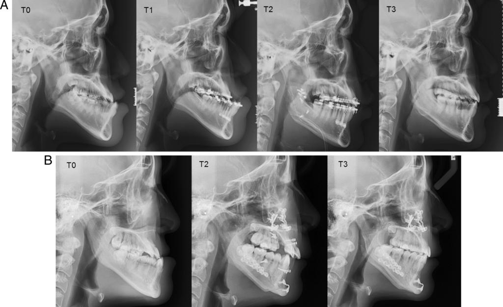 721 CHANGE IN UPPER INCISORS OF CLASS III AND SFA Tble 1.