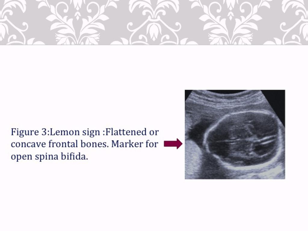 Fig. 9: Ultrasound image showing