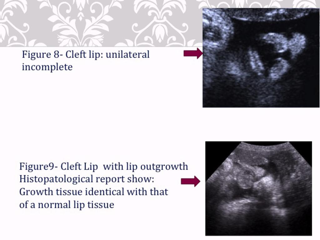 Fig. 14: Ultrasound images showing cleft lip