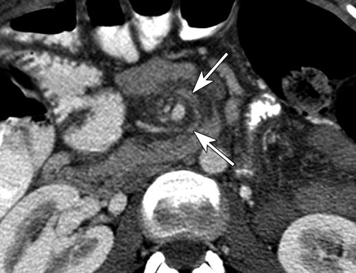 Fig. 1 39-year-old woman with internal hernia. CT sign, mesenteric swirl.