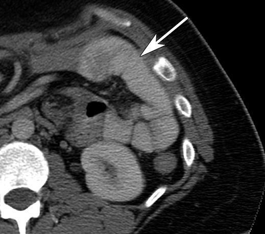 CT of Hernia After Gastric Bypass Fig. 3 36-year-old woman with internal hernia. CT sign, clustered loops of small bowel.