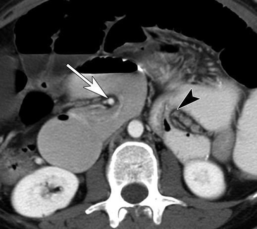CT sign, distal tubular mesentery with surrounding loops of small bowel.