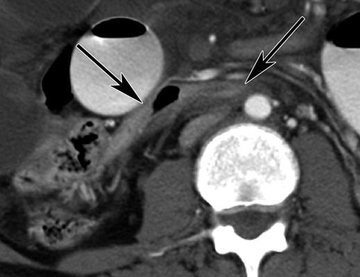 Enhanced transverse CT scan through mesenteric root shows narrowed mesenteric root with fat and vessels passing between superior mesenteric artery (arrow) and distal mesenteric arterial branch