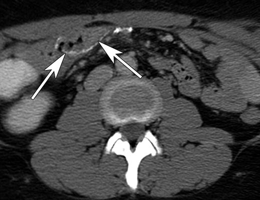 Fig. 7 34-year-old woman with internal hernia. CT sign, right-sided anastomosis.