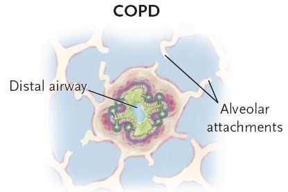 Chronic Obstructive Pulmonary Disease (COPD) l Definition: Group of chronic lung diseases that impairs airflow and makes breathing more difficult.