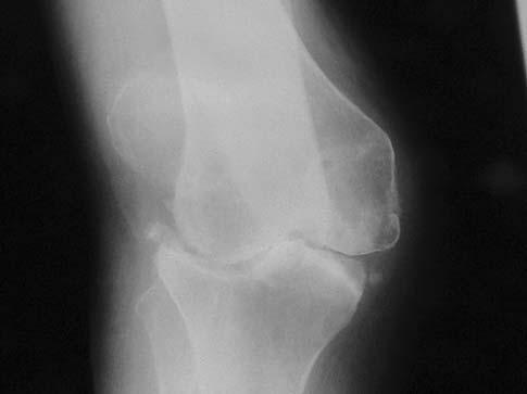 Fifty-two knees (39 patients) were in women and 12 knees (eight patients) were in men. Mean age of the patients at the time of surgery was 49.5 ± 8.6 years (range, 28 64 years).