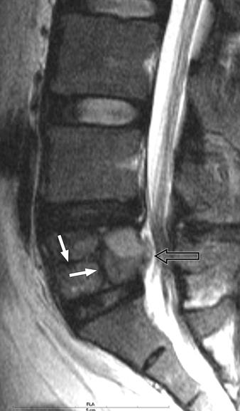 MRI of Spinal Tumors TLE 1: Clinical Features and MRI Findings of Giant Cell Tumors of the Spine Patient No.