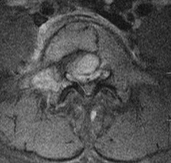Destruction on CT 1 28 M S1 Radiating pain to right lower 8 + + + + 10.5 N extremity 2 31 F L5 Radiating pain to right lower 4 + + + + 6.0 N extremity 3 48 M S3 Sacral pain 3 + + + + 9.