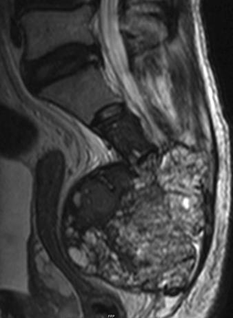 C Fig. 2 Giant cell tumor of sacrum in 48-year-old man (patient 3).