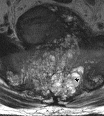 , xial T2-weighted MR image (4,010/117) shows fluid fluid level (asterisk) in tumor.