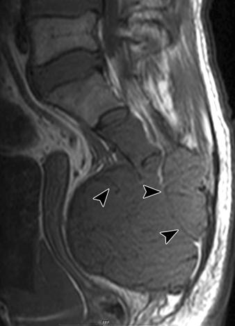 D, Enhanced sagittal T1-weighted MR image (576/13) shows marked and heterogeneous enhancement and multiple focal cystic changes (arrows). (Fig.