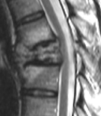 Fig. 3 Giant cell tumor of T5 T7 in 36-year-old man (patient 6)., Sagittal T2-weighted fast spin-echo MR image (TR/TE, 2,500/120) shows collapse of T6 vertebra and tumor spread to T5 and T7 vertebrae.