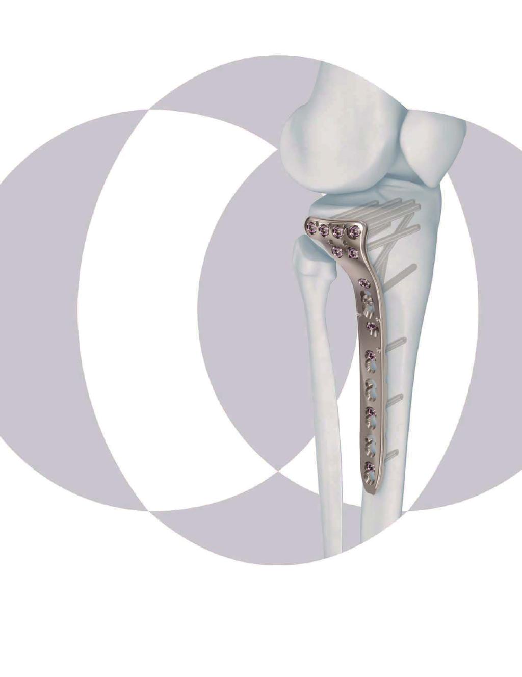 3.5 MM VA-LCP PROXIMAL TIBIA PLATE SYSTEM Part of the DePuy