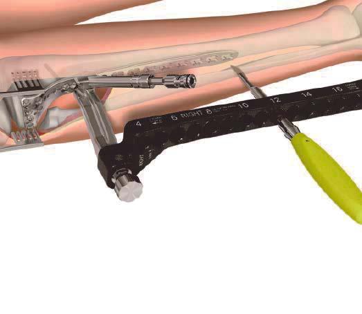 Plate Insertion and Fixation Optional instrument 03.113.011 Scalpel Handle for 3.5 mm LCP Percutaneous Instrument System Attach a blade to the scalpel handle.
