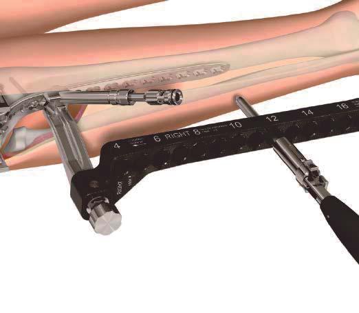 Plate Insertion and Fixation Insert the trocar with handle into a locking/neutral guide for the VA-LCP proximal tibia plate.