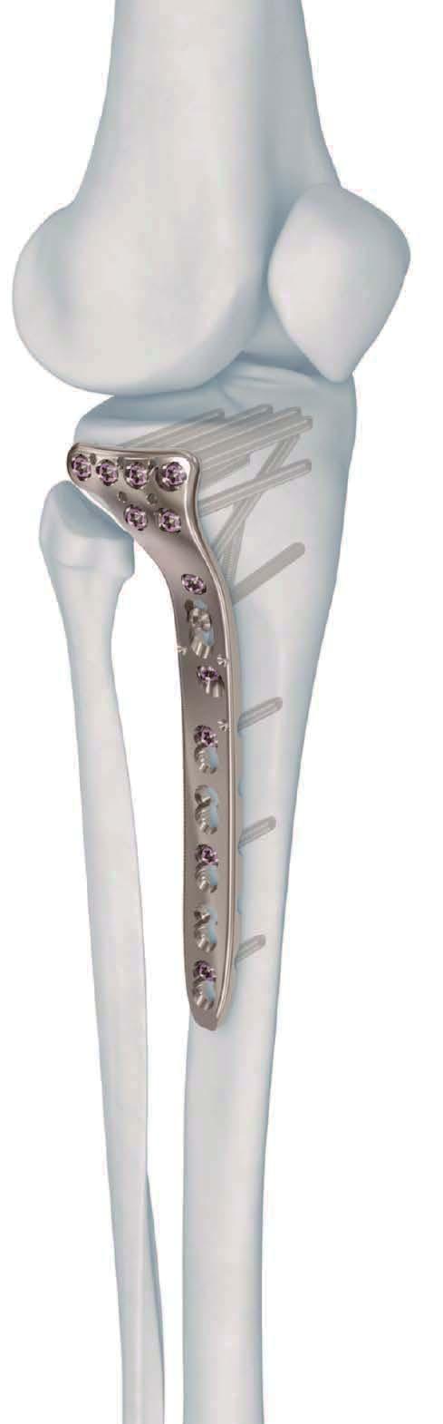 3.5 MM VA-LCP PROXIMAL TIBIA PLATE SYSTEM. Part of the Variable Angle Periarticular Plating System. The DePuy Synthes 3.
