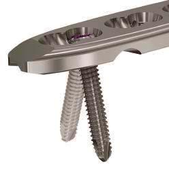 5 mm variable angle locking screw is rounded to facilitate various angles within the locking hole Available in stainless steel Available sterile and nonsterile Plate allows for placement of two