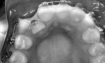 , conducted demonstrates that Damon passive self-ligating brackets are equally effective in delivering torque to maxillary incisor teeth relative to conventionally ligated brackets.