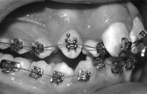 This loss of torque is often referred to as wireto-lumen play 2 and can have deleterious effects on the expressed torque, the axial inclination of teeth and ultimately the ability of the clinician to