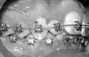 We all have to take wire-to-lumen play into consideration when planning torque values for ideal tooth and root positions. Major mechanics (e.g., Class II elastics) also attributes to torque loss in maxillary anterior teeth.