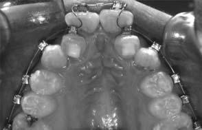 The loss of torque in the maxillary anterior teeth from wire play 2 in combination with the Class II elastics can be easily offset by placing at least +10 º (and up to +20 º ) of palatal root torque
