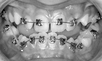 posterior vertical elastics will help extrude the posterior teeth, thereby