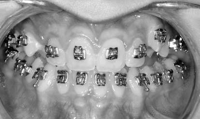 This Class III case demonstrates remarkable progress achieved with the use of