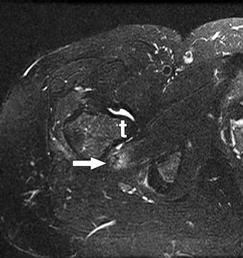MRI of Quadratus Femoris Muscle Tear also present in this region in the case of avulsion of the quadratus femoris tendon (Fig. 3B). Fig.