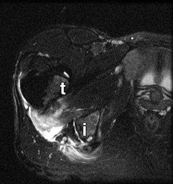 A, Axial T2-weighted fat-suppressed image reveals disruption and proximal retraction of right quadratus femoris muscle fibers between lesser (t) and ischial tuberosity (i).