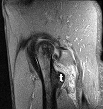 B, Sagittal proton density fat-suppressed image reveals disrupted muscle fibers with edema and hemorrhage within quadratus femoris muscle located posterior to lesser (t).