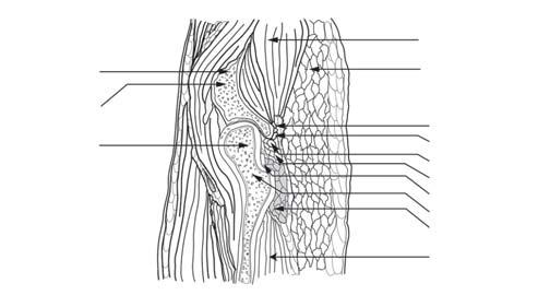Trochanteric fossa Interic crest Insertion of obturator externus Greater Insertion of quadratus femoris Ilium Anterior inferior iliac spine Femur, neck increasing the diagnostic difficulty.