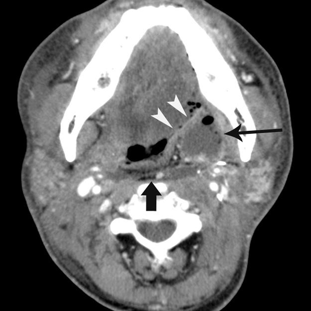 Post-Operative CT in Predicting Delayed Flap Failures no significant differences were observed between the two groups in terms of age and gender of patients, T-stage of primary tumor, and time