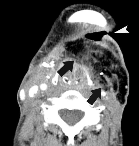 Contrast-enhanced CT scan 6 days after operation shows fat-containing flap (arrows) with intra-flap fluid collection (long arrow) in left submandibular space and air collection (arrowhead) in left