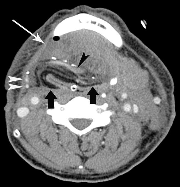 Cutaneous fistula (arrowhead) is also noted in left submandibular area.