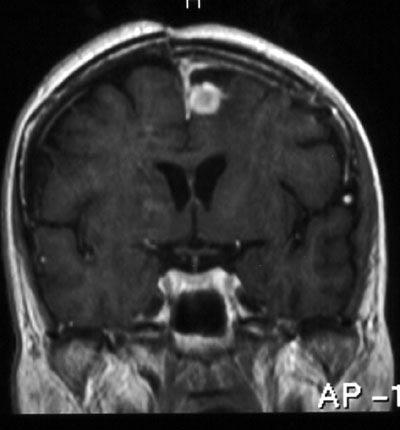 Early Post-Operative MRI in Malignant Gliomas A B C D Fig.